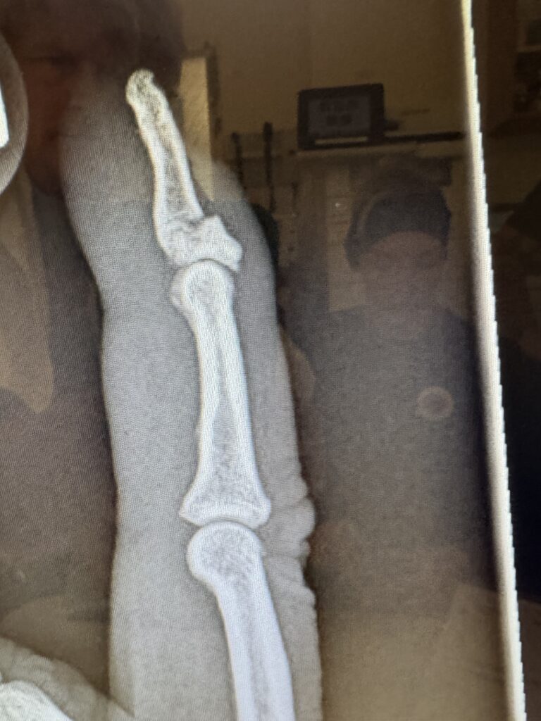 Side-view X-ray image of a finger showing the finger bones and joints.